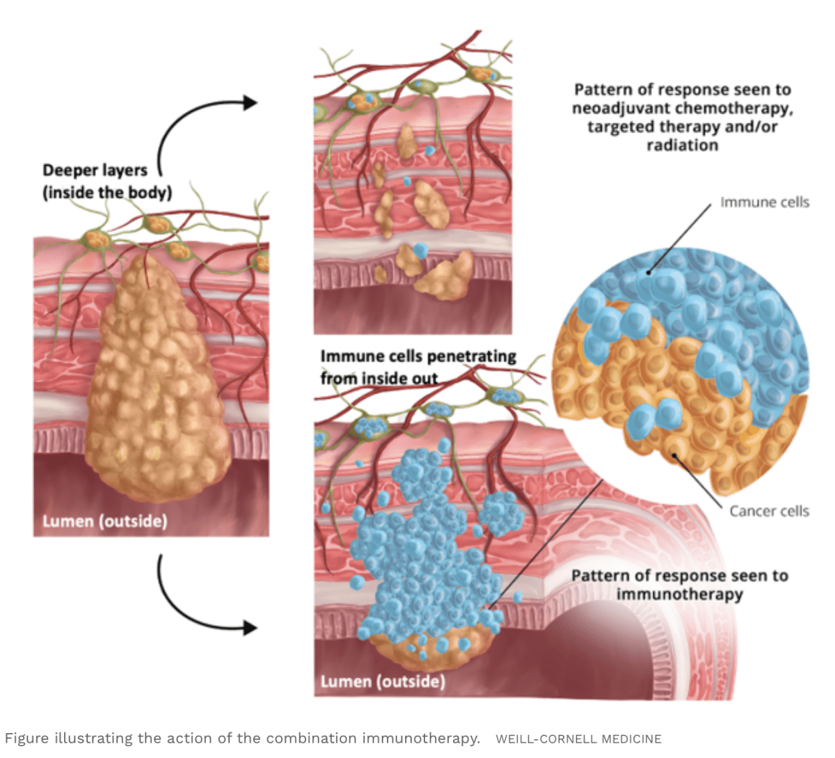New Drug Combo Shows Promising Results Against Early Stages Of Colorectal&nbsp;Cancer