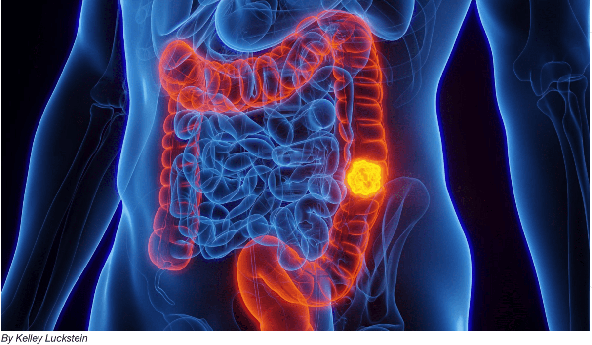 Methylated DNA Markers for Sporadic Colorectal and Endometrial Cancer Are Strongly Associated with Lynch Syndrome&nbsp;Cancers